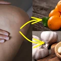 Masz problem z żylakami? Możesz je usunąć dzięki temu domowemu sposobowi!