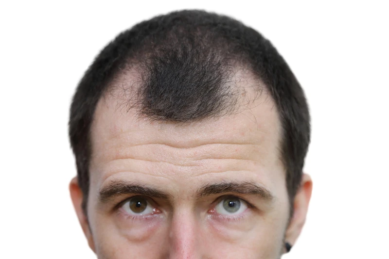 Jak zapobiec łysieniu?