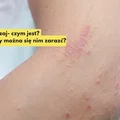 Masz takie znamię na skórze? Sprawdź czym jest liszaj i jak go wyleczyć?