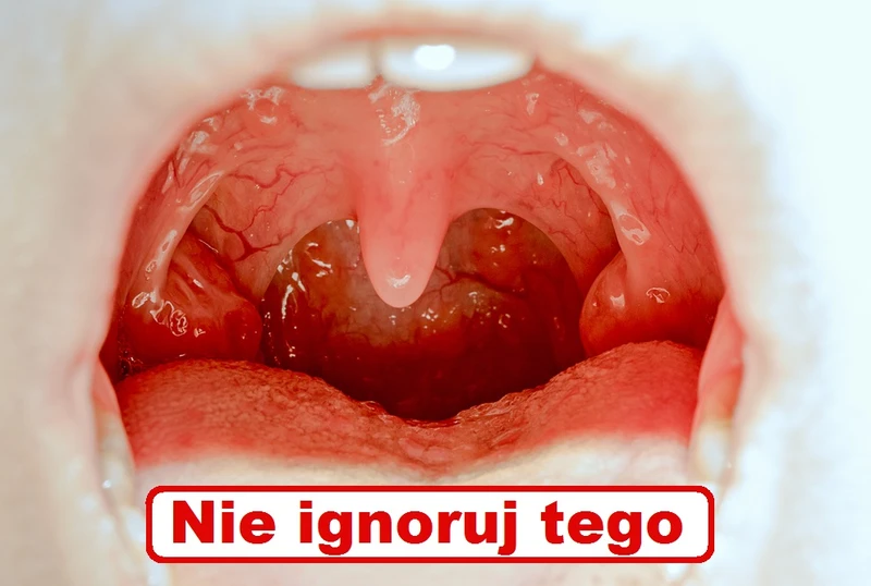 ZAPALENIE MIGDAŁKÓW – Zobacz objawy których nie wolno ignorować