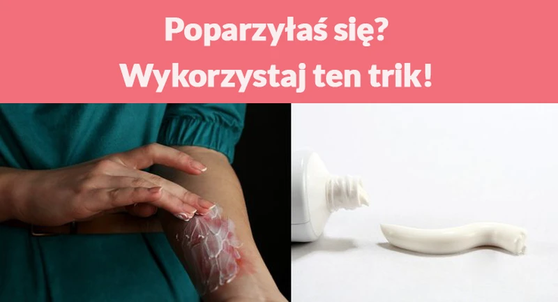 Poparzyłaś się? Wykorzystaj ten trik!