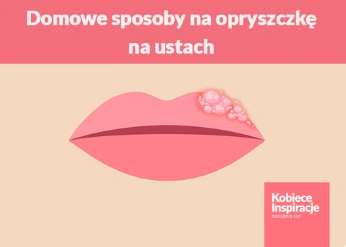 Domowe sposoby na opryszczkę na ustach - 5 SPRAWDZONYCH METOD