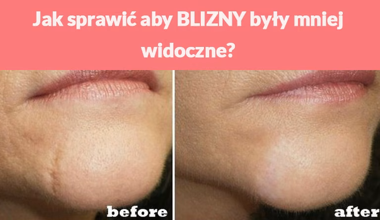 Jak sprawić aby BLIZNY były mniej widoczne?