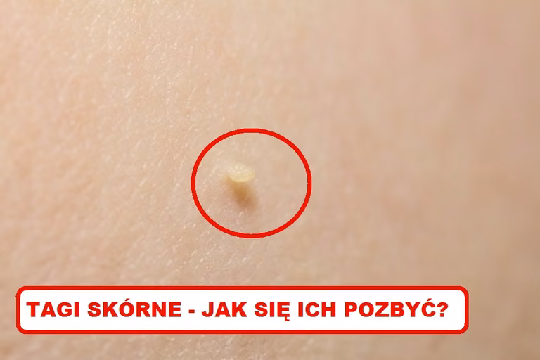 TAGI SKÓRNE – Zobacz jak się ich pozbyć