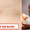 Wykorzystaj właściwości CEBULI i zmniejsz widoczność BLIZN!