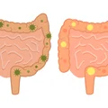 5 objawów zaburzonej flory bakteryjnej jelit