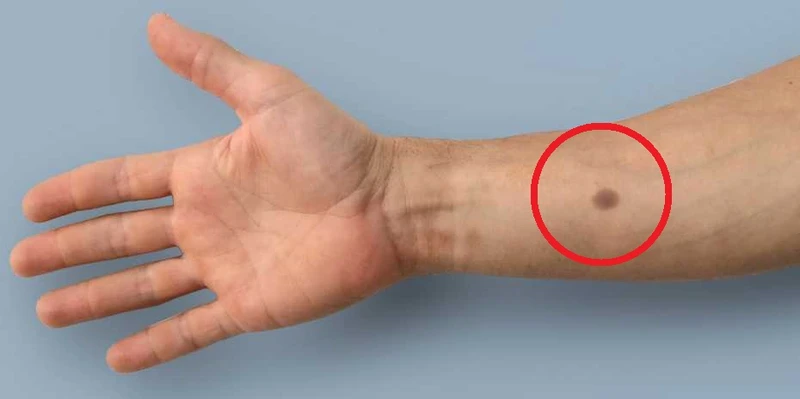 HIT! Stworzono implant wykrywający raka