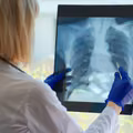 Światowy Dzień Gruźlicy: Walka z Jedną z Najstarszych Chorób Zakaźnych