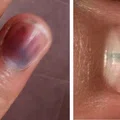 Zwykły krwiak, czy czerniak podpaznokciowy? Nie ignoruj tych objawów