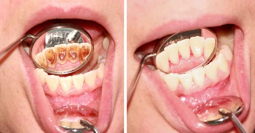 Większość z nas myśli, że potrafi zadbać o higienę jamy ustnej. Jednak często popełniamy te błędy