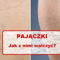 Zauważyłaś na swoim ciele tzw PAJĄCZKI? Pozbądź się ich domowym sposobem