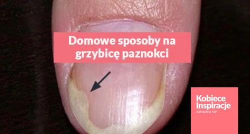 Domowe, skuteczne sposoby na leczenie grzybicy paznokci