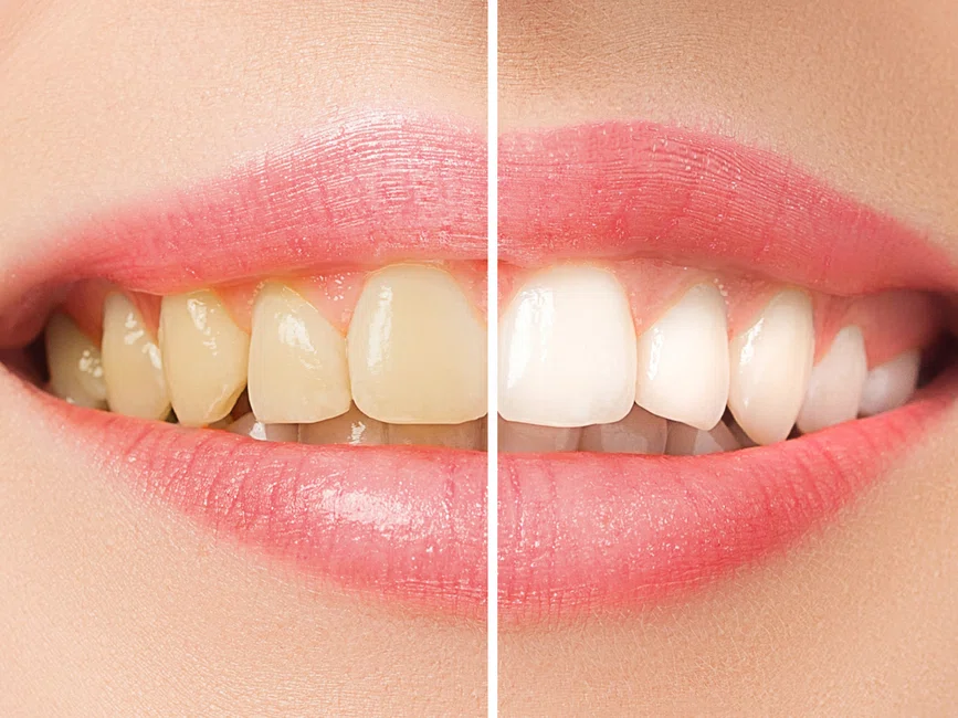 Co najbardziej barwi zęby? Poznaj 8 produktów!