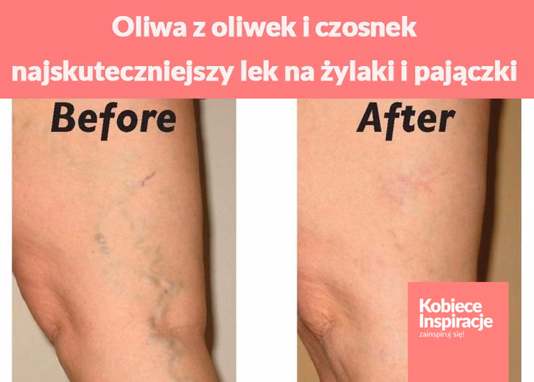 Oliwa z oliwek i czosnek - najskuteczniejszy lek na żylaki i pajączki. Sprawdź jak to zrobić