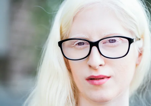 Międzynarodowy Dzień Świadomości nt. Albinizmu: Zrozumieć i Wspierać