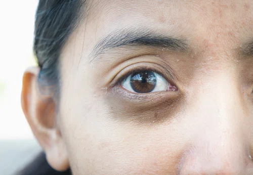 Jakie są przyczyny powstawania cieni pod oczami? To wiele mówi o twoim zdrowiu