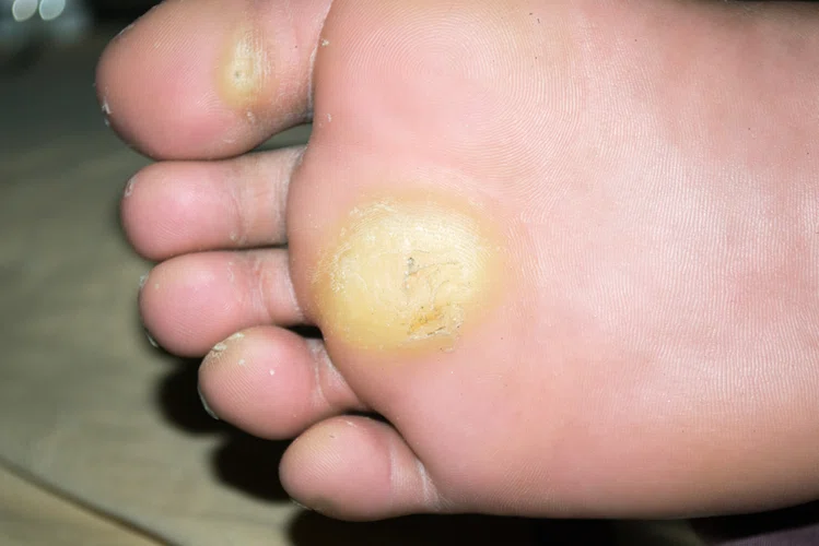 Zdjęcie 5 chorób, które rozpoznasz po swoich stopach! #5