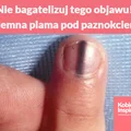 Nie bagatelizuj tego objawu! Ciemna plama pod paznokciem może świadczyć o poważnej chorobie