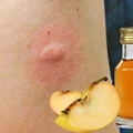 Zapomnij o ukąszeniach komarów! Pij jedną łyżkę dziennie, a odstraszysz je na dobre!