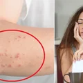 Masz te objawy? To może być alergia. Sprawdź, na co możesz być uczulony
