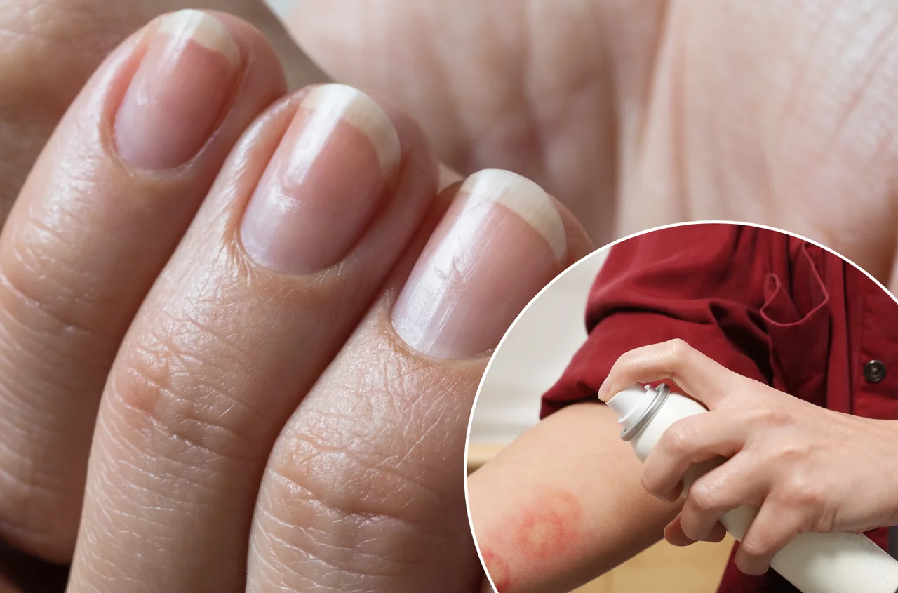 Ten preparat na oparzenia sprawia, że paznokcie rosną szybciej!