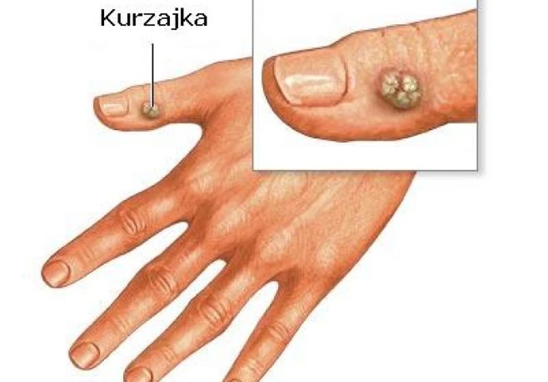 Jak pozbyć się kurzajek domowym sposobem?