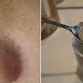 Maseczka z żelatyną na zaskórniki