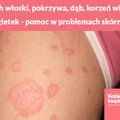 Orzech włoski, pokrzywa, dąb, korzeń wierzby i nagietek - Twoja pomoc w problemach skórnych