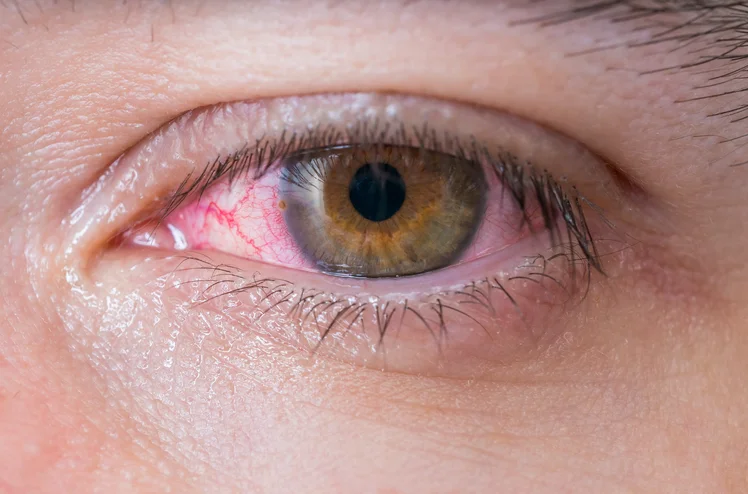 Zdjęcie Czy zapaleniem spojówek można się zarazić? Oto, co musisz wiedzieć o "różowym oku"! #1