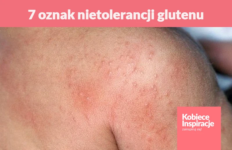 7 oznak nietolerancji glutenu
