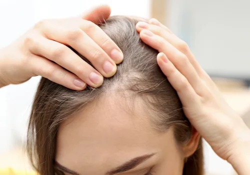 Wypadanie włosów i trądzik po 30-tce? Sprawdź swoje hormony!