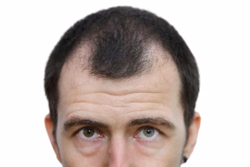 Jak zapobiec łysieniu?