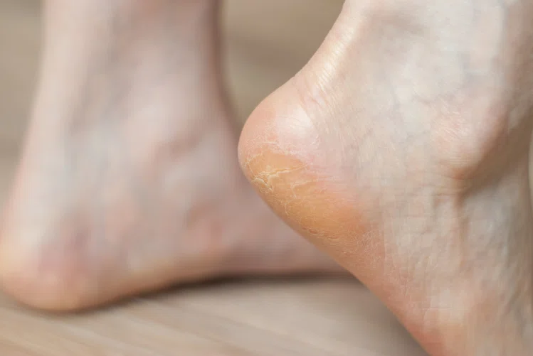 Zdjęcie 5 chorób, które rozpoznasz po swoich stopach! #4