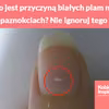 Co jest przyczyną białych plam na paznokciach? Nie ignoruj tego