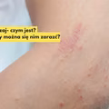 Masz takie znamię na skórze? Sprawdź czym jest liszaj i jak go wyleczyć?