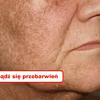 Naturalne sposoby na PRZEBARWIENIA NA SKÓRZE