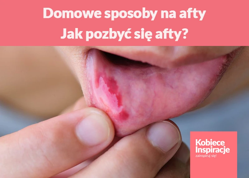 Domowe sposoby na afty - jak pozbyć się afty?
