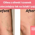 Oliwa z oliwek i czosnek - najskuteczniejszy lek na żylaki i pajączki. Sprawdź jak to zrobić