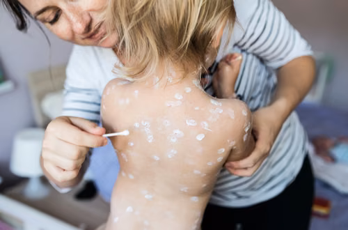 Ile razy w życiu można zachorować na ospę wietrzną? Obalamy najpopularniejsze mity