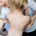 Ile razy w życiu można zachorować na ospę wietrzną? Obalamy najpopularniejsze mity