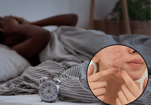 Nie możesz spać? Ten suplement na stres pomoże ci także w walce z trądzikiem!