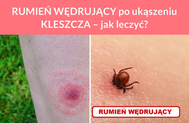 RUMIEŃ WĘDRUJĄCY po ukąszeniu KLESZCZA – jak leczyć?
