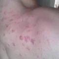 Co jest przyczyną występowania pryszczy w różnych miejscach na ciele?