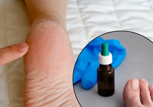 Płyn na grzybicę paznokci działa cuda na… suche skórki i popękane pięty!
