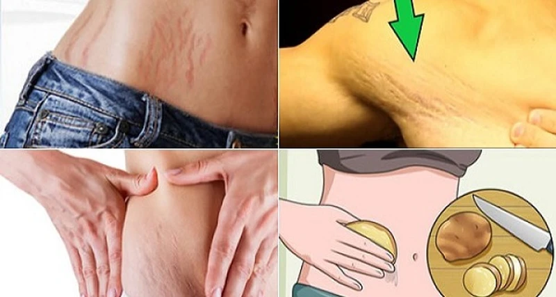 4 domowe sposoby na pozbycie się rozstępów!