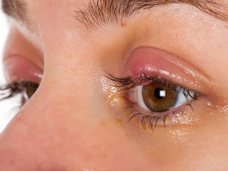 Zdjęcie Dlaczego skóra wokół oczu jest podrażniona? Sprawdź możliwe przyczyny! #4