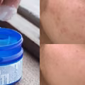 Vicks – genialne zastosowania miętowej maści, o których nie miałeś pojęcia!