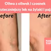 Oliwa z oliwek i czosnek - najskuteczniejszy lek na żylaki i pajączki. Sprawdź jak to zrobić