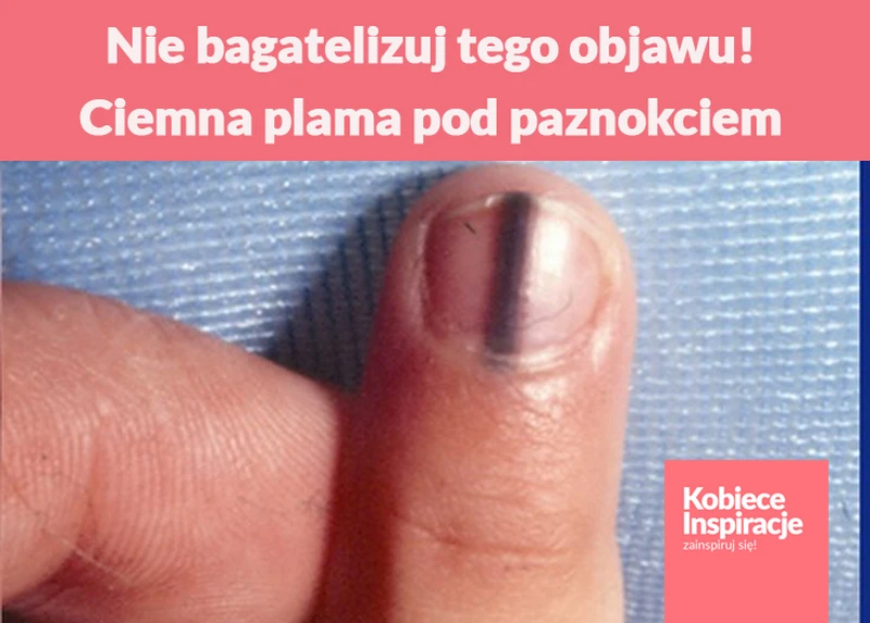 Nie bagatelizuj tego objawu! Ciemna plama pod paznokciem może świadczyć o poważnej chorobie
