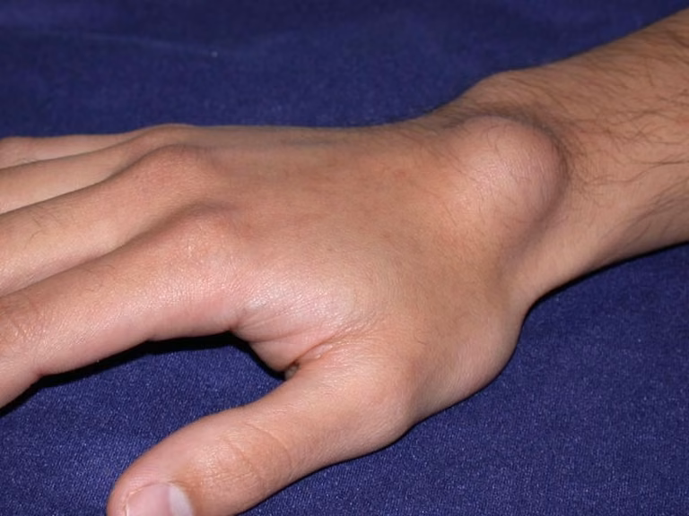 Ganglion – guz na nadgarstku. Jakie mogą być jego skutki?
